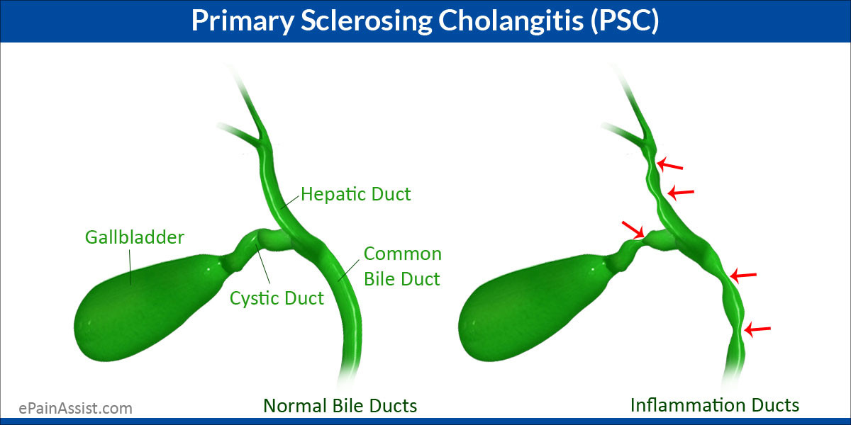 Kolangitis Sklerosing Primer (Primary Sclerosing Cholangitis)